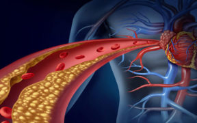 Ateroskleróza – kôrnatenie ciev